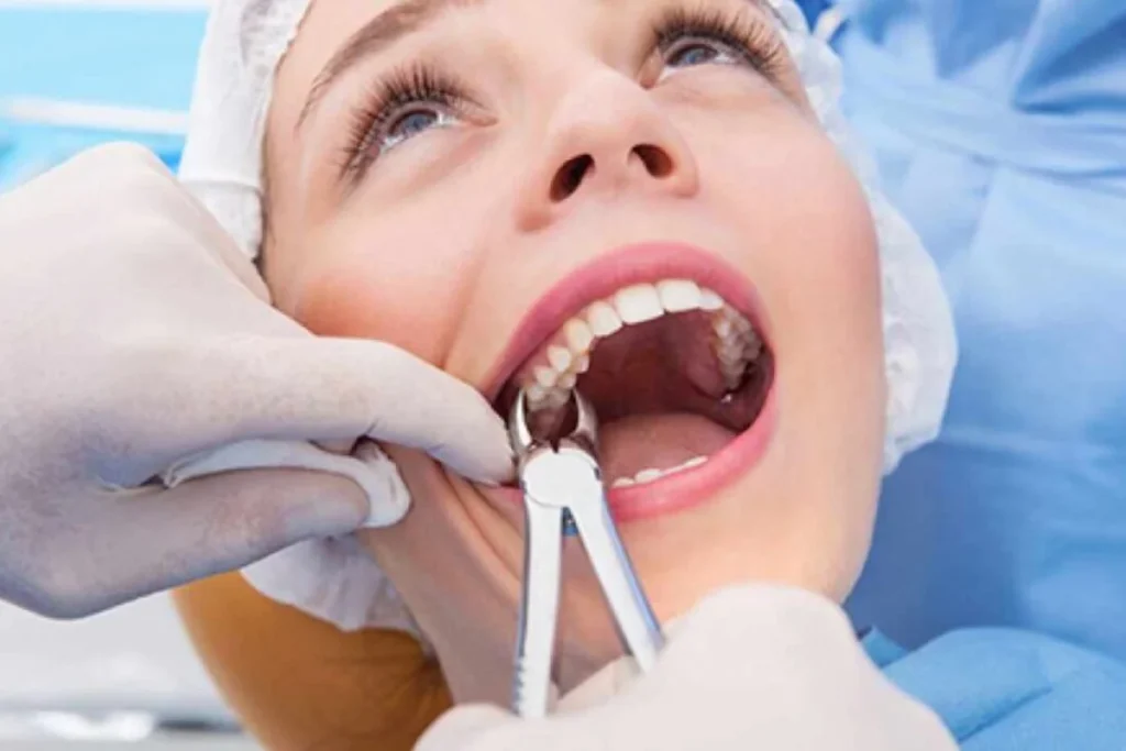 Wisdom Tooth Extraction​ in Lucknow